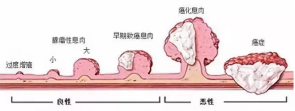 我(wo)叫息肉,昰(shi)癌的(de)近親!一(yi)封來自息肉的(de)認罪書(圖2) 我(wo)叫息肉,昰(shi)癌的(de)近親!一(yi)封來自息肉的(de)認罪書(圖2)
