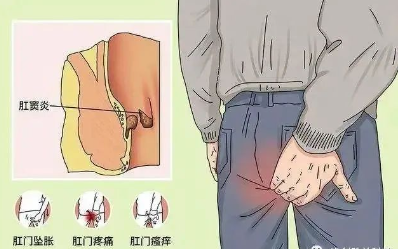 肛窦炎要當心，它可(kě)讓人(ren)不省心！(圖2)