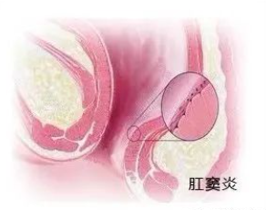 肛窦炎要當心，它可(kě)讓人(ren)不省心！(圖3)
