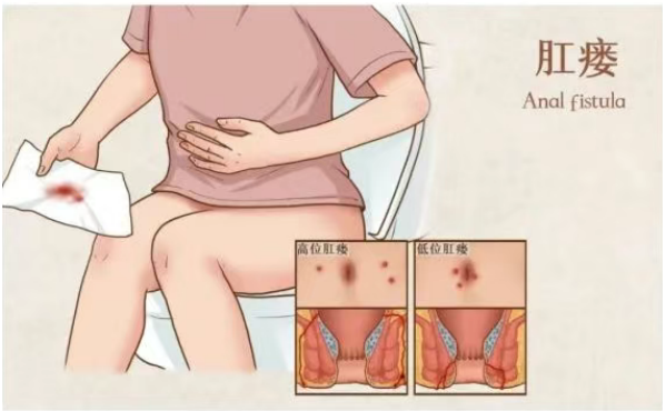 肛瘘症狀有(yǒu)哪些？怎麽知道自己昰(shi)不昰(shi)患上肛瘘了(le)呢(ne)？(圖1)